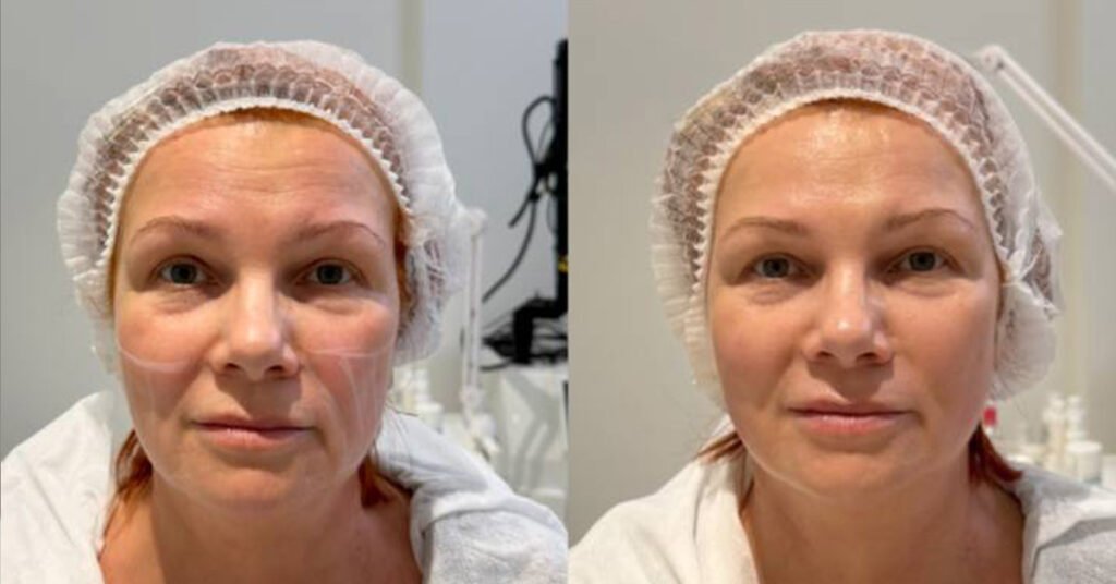 a2-smas-facelift-before-after_2_1200x628px