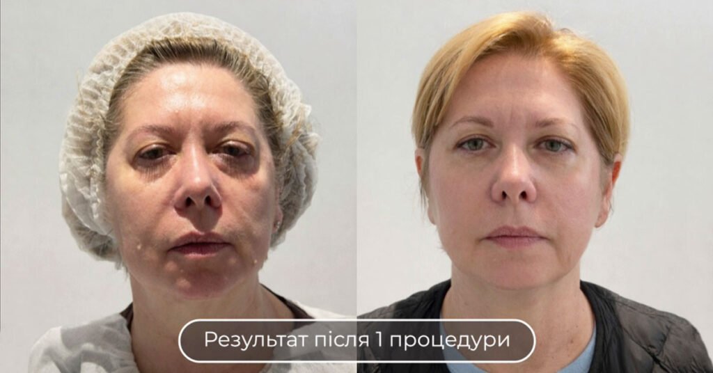 a2-smas-facelift-before-after_full_1200x628px